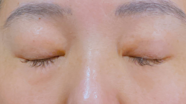 Preoperative Condition Part 1