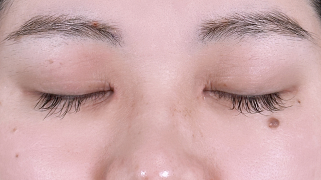 Preoperative Condition Part 1